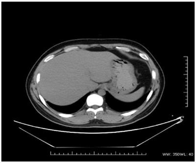 Type II Crigler-Najjar syndrome: a case report and literature review
